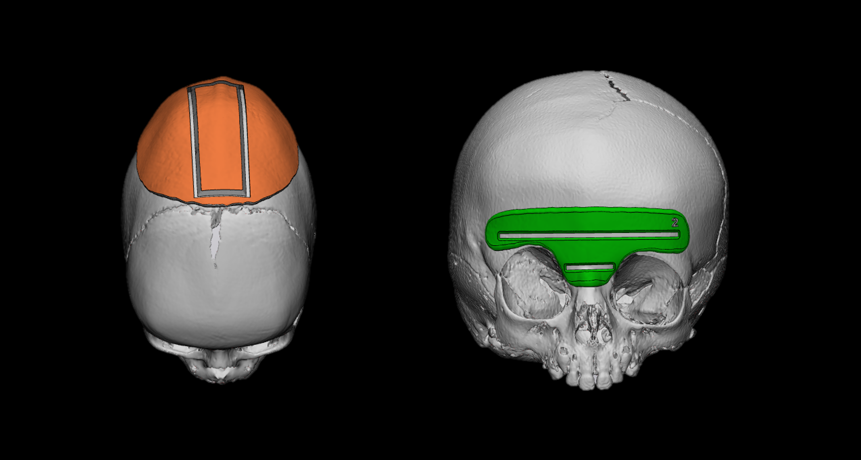 craniosynostosis